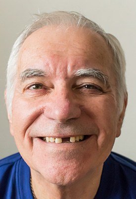 Patient in Shelby smiling with missing tooth