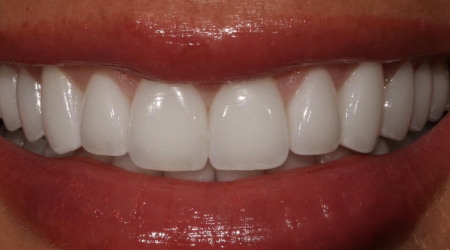 Close up of a smile with straighter and whiter teeth