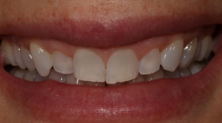 Close up of a smile with slightly darkened and misaligned teeth
