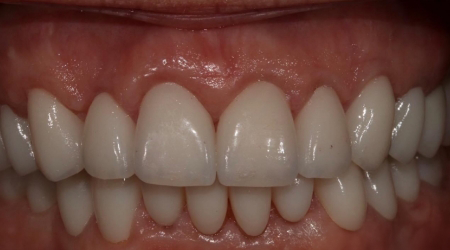 Close up of a smile with whiter and more uniform teeth