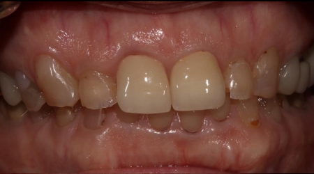 Close up of a smile with yellowed and misshapen teeth
