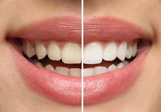 A smile before and after teeth whitening