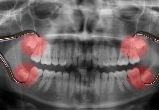 Dental X-ray showing impacted wisdom teeth