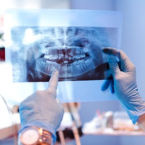 Dentist pointing out wisdom teeth on X-Ray