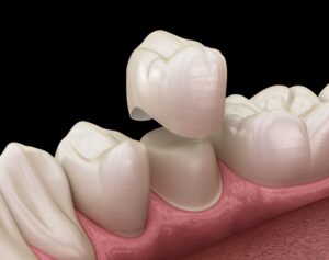 Dental crown.