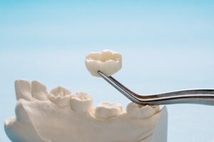 Dental crown.