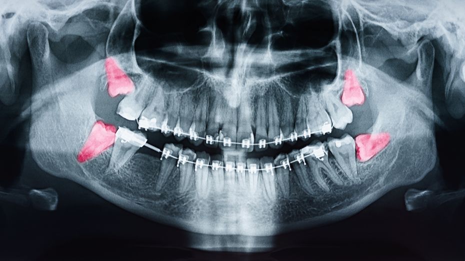 A dental X-ray showing wisdom teeth