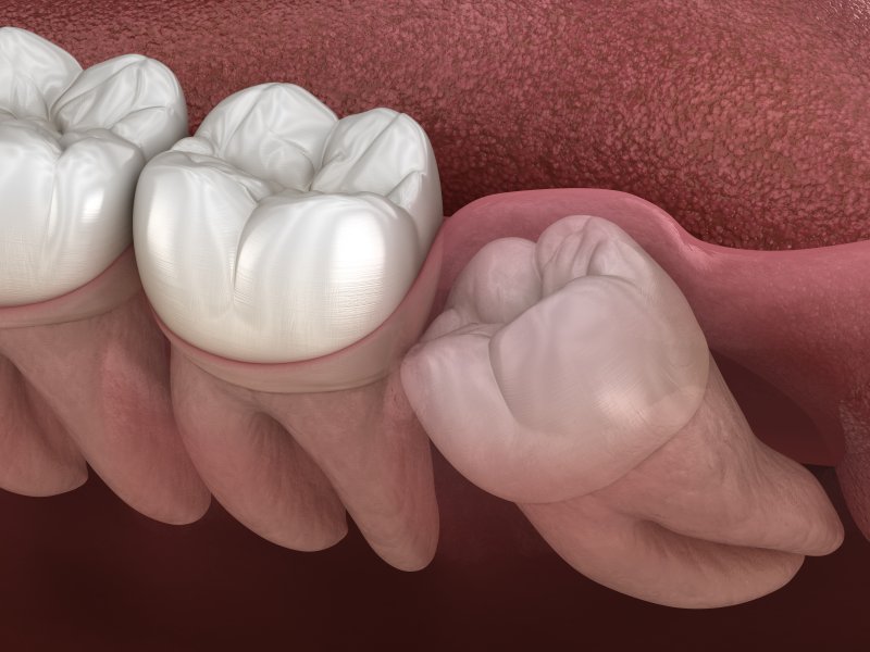 A 3D illustration of an impacted wisdom tooth