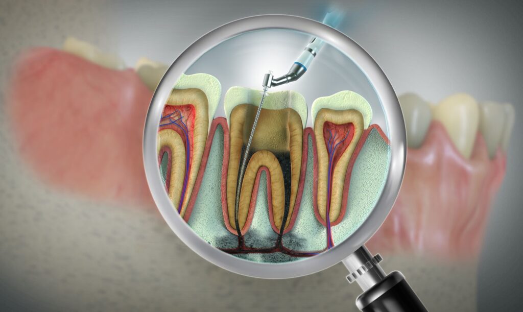 A CGI of a root canal